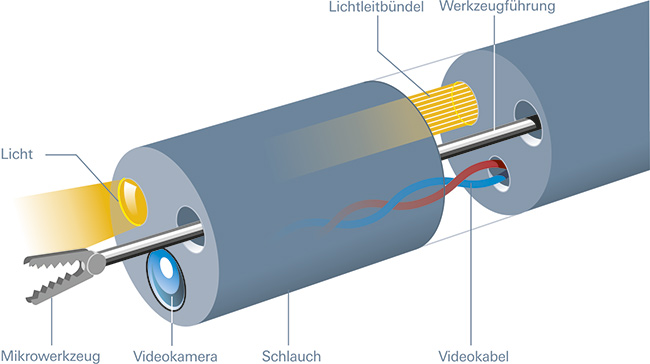 Schnittgrafik eines Instrumentes zur Kolposkopie. Am Ende des Schlauches befinden 
	sich ein Mikrowerkzeug, eine Videokamera und ein Lichtaustritt.