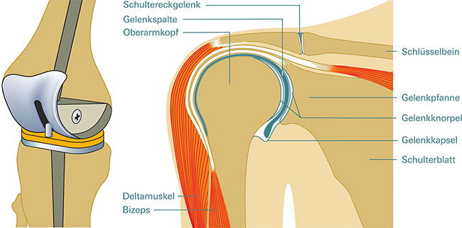 Medizinische Grafik Schultergelenk und Kniegelenk. Die linke Illustration zeigt ein Kniegelenk mit einer Scharnierprothese. Die rechte Illustration zeigt den Aufbau eines Schultergeleks mit der Gelenkpfanne, dem Oberarmkopf, Schlüsselbein und Gelenkknorpel.