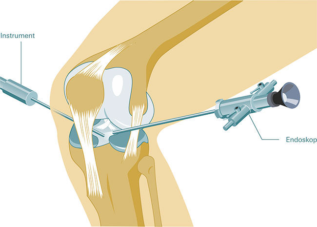 Grafik Arthroskopie. Der Operateur schaut durch das Endoskop in das Kniegelenk. 
	Andere, in das Knie eingeführte Instrumente ermöglichen dem Arzt die Operation. Zum Beispiel die Knorpelrekonstruktion